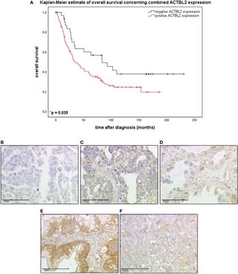 Actin Beta-Like 2 as a New Mediator of Proliferation and Migration in Epithelial Ovarian Cancer